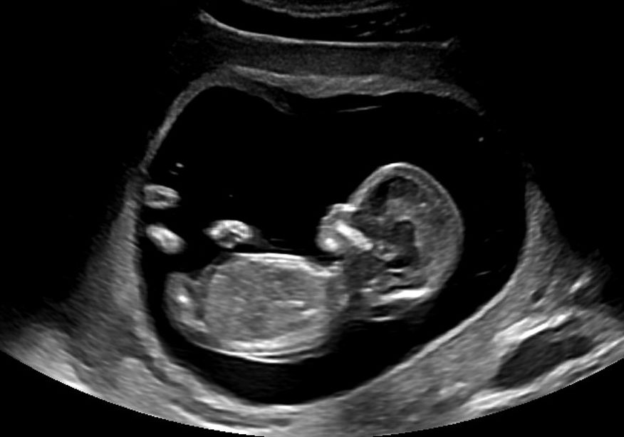 妊娠12週目のエコー画像